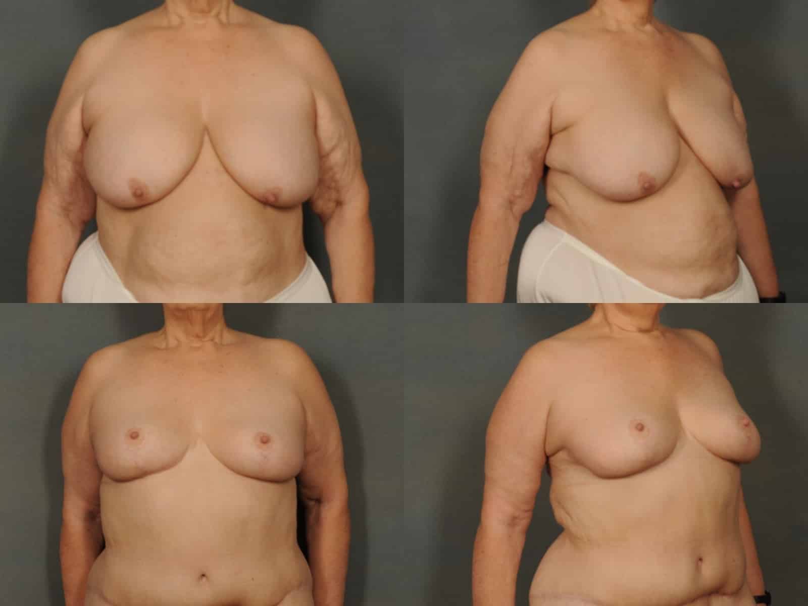 Breast Reduction Case# 852 Combined Image