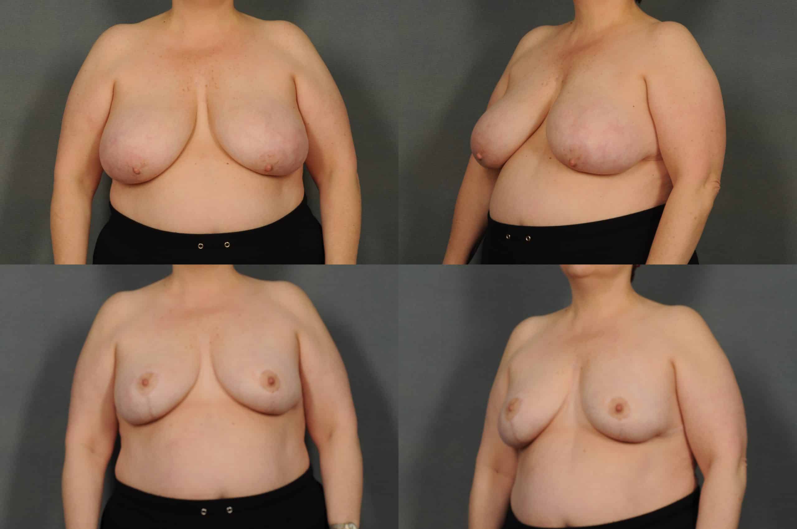 Breast Reduction Case# 864 Combined Image