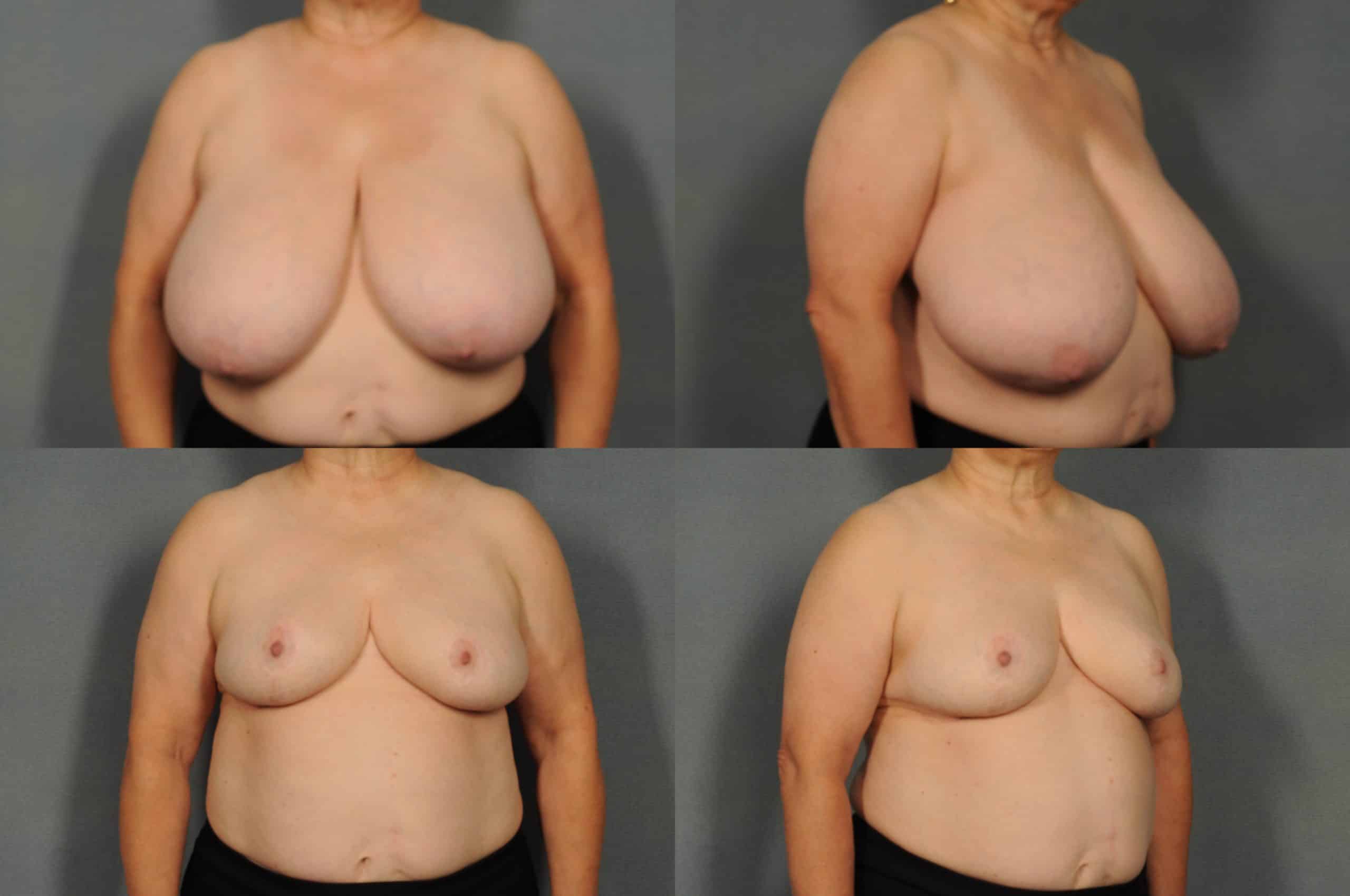 Breast Reduction Case# 886 Combined Image