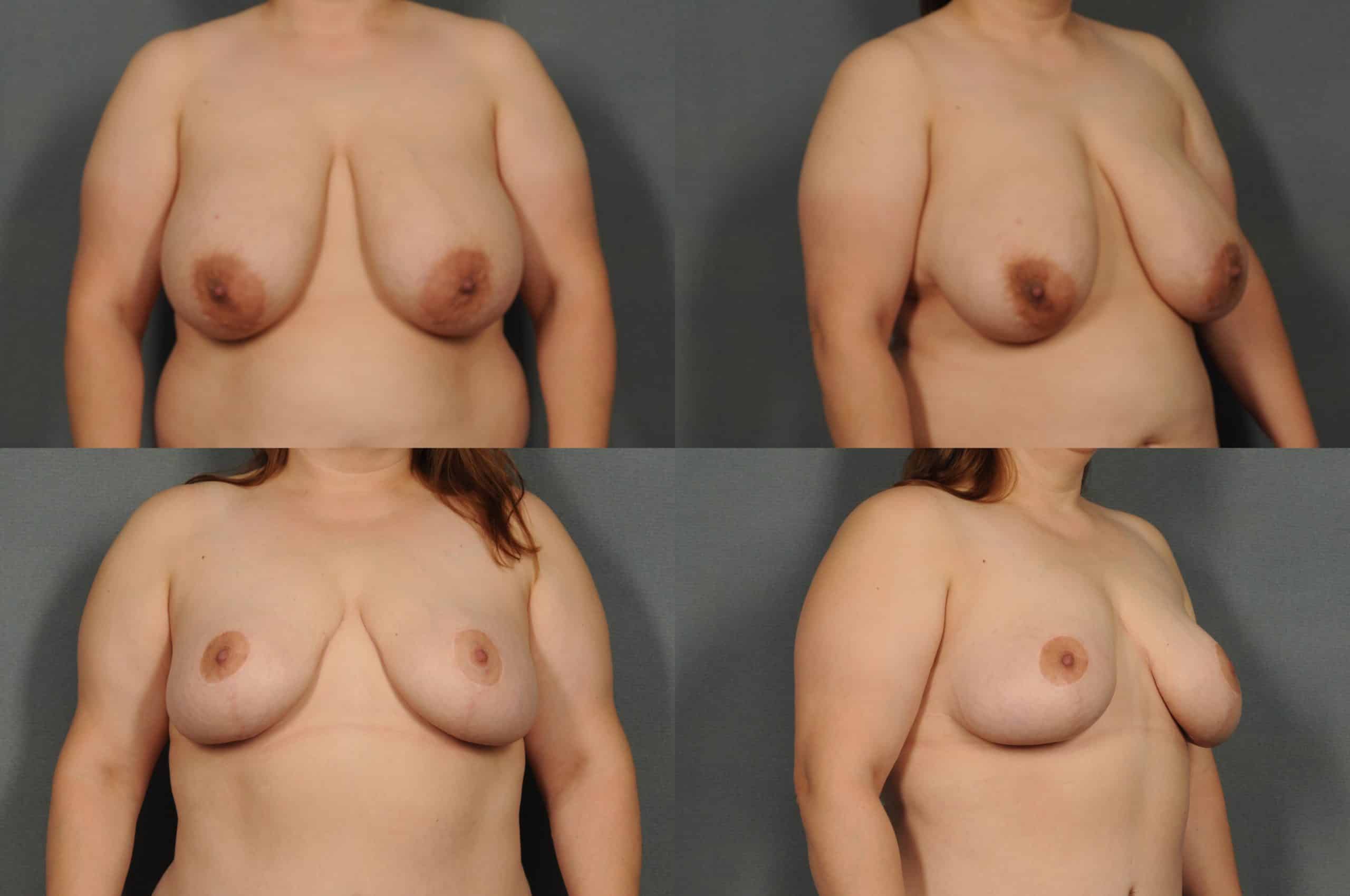 Breast Reduction Case# 887 Combined Image