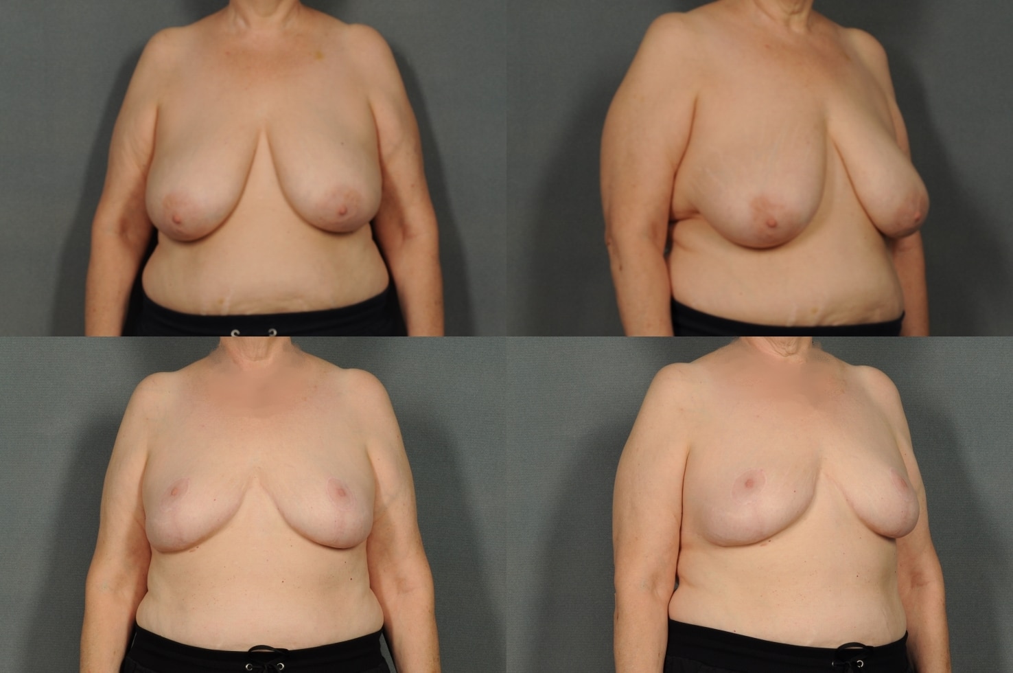 Breast Reduction Case# 888 Combined Image