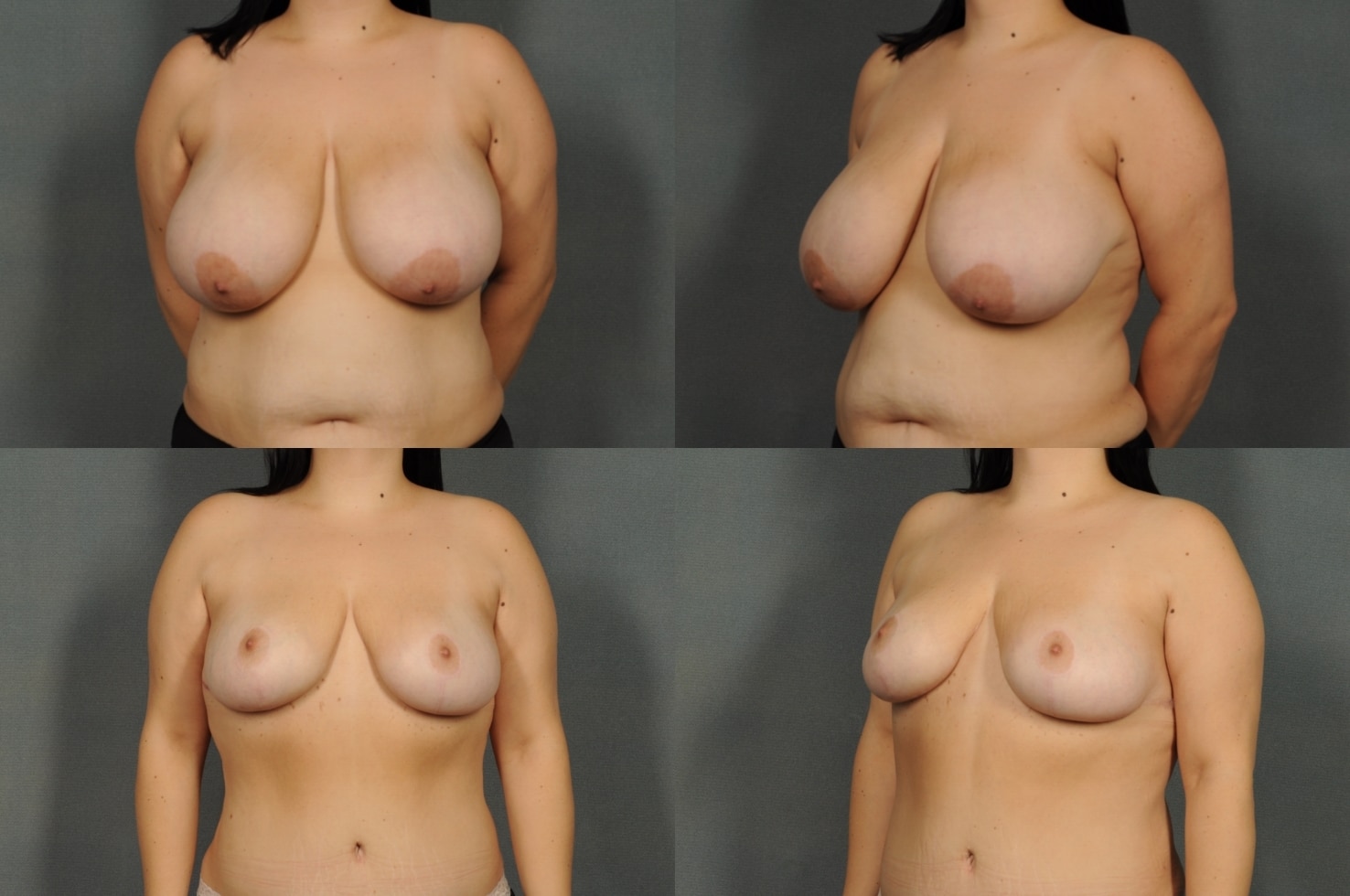 Breast Reduction Case# 896 Combined Image