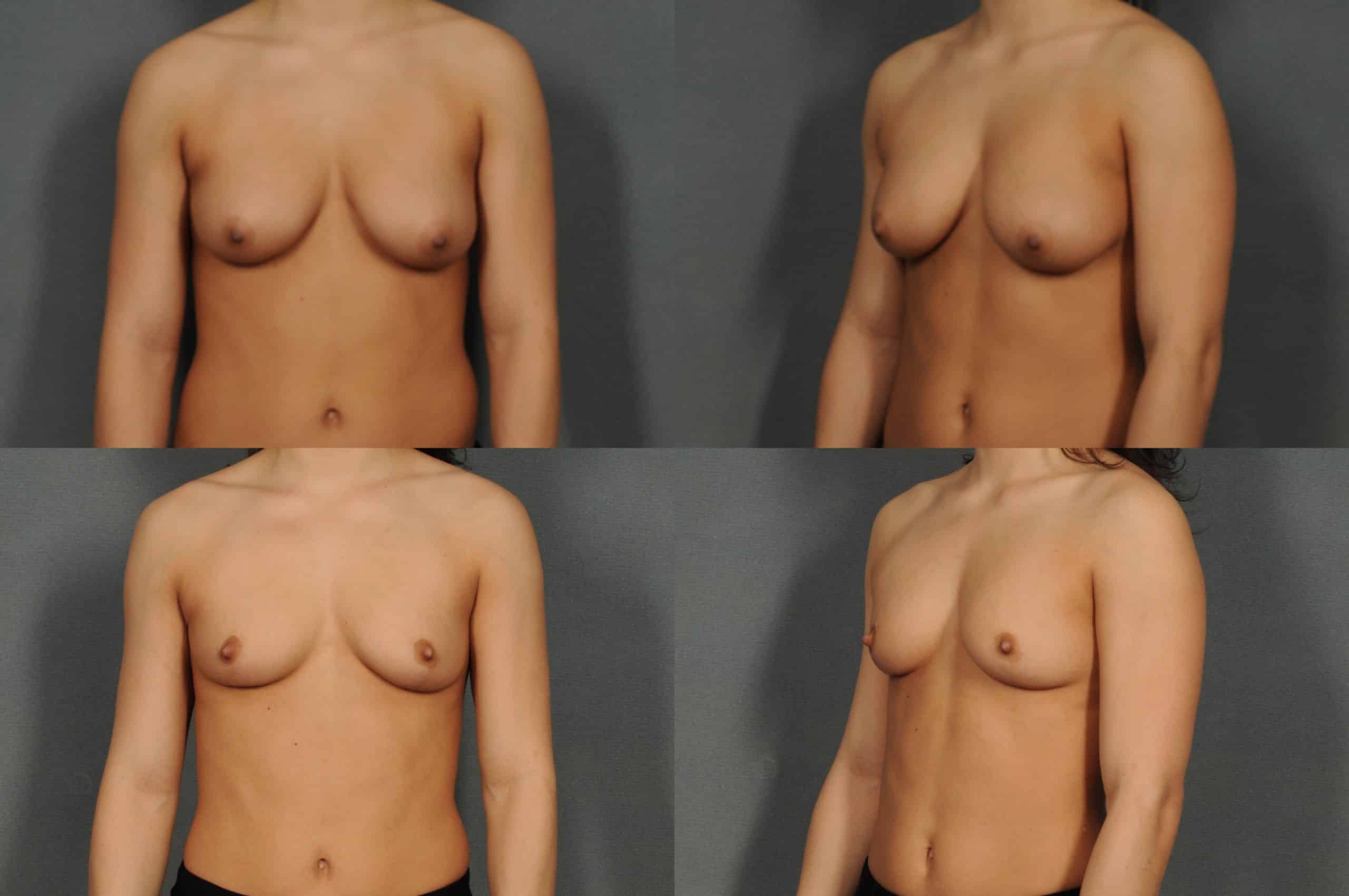 Breast Reduction Case# 901 Combined Image