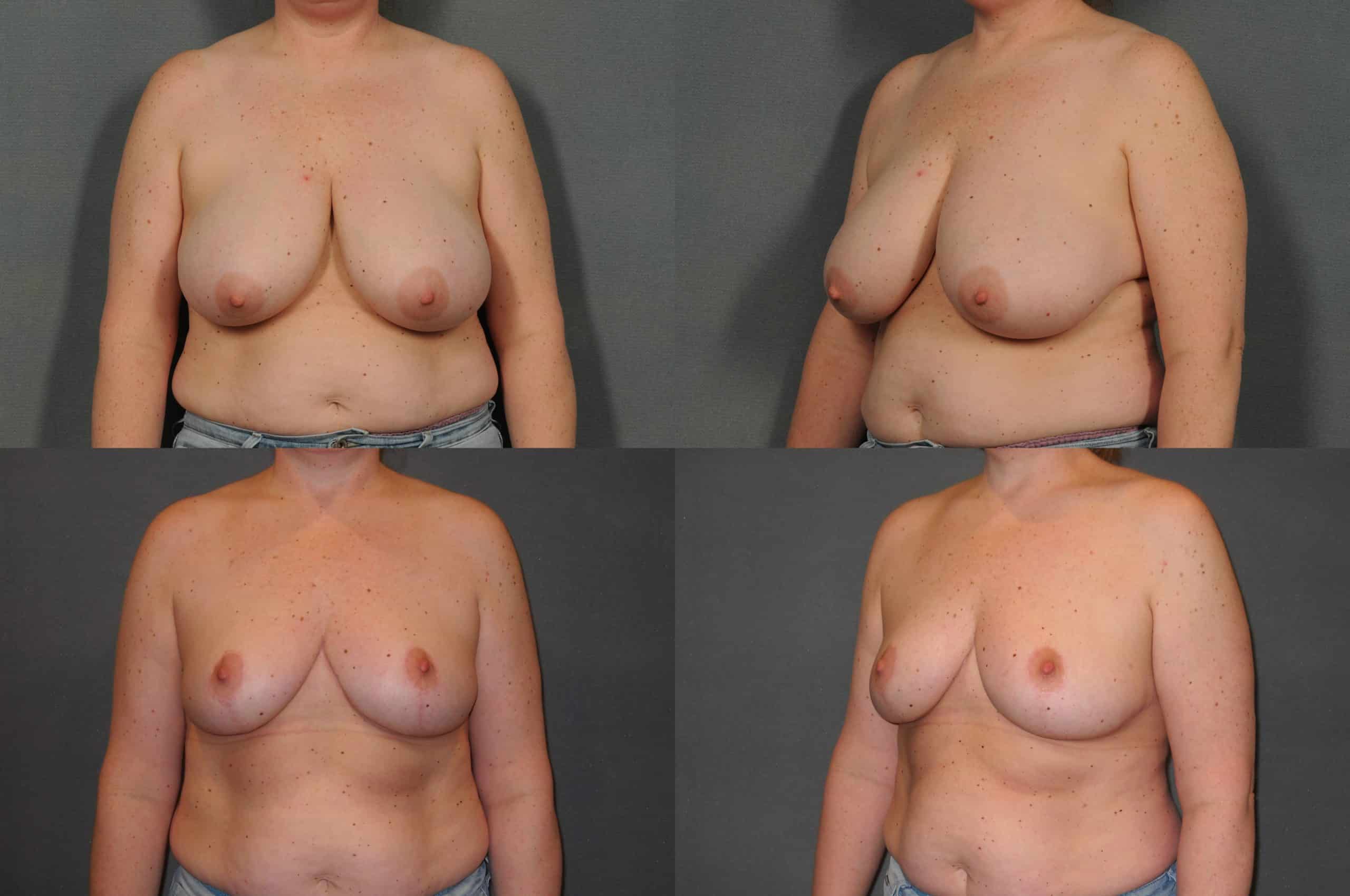 Breast Reduction Case# 903 Combined Image