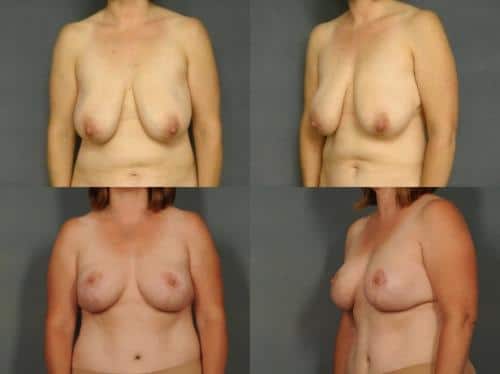 Breast Reduction Case #911 Combined Image