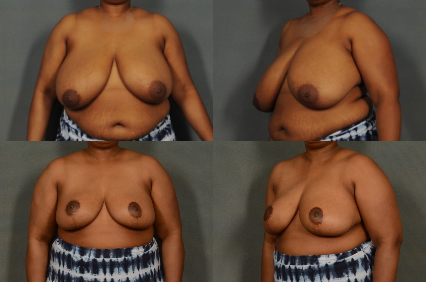 Breast Reduction Case# 911 Combined Image