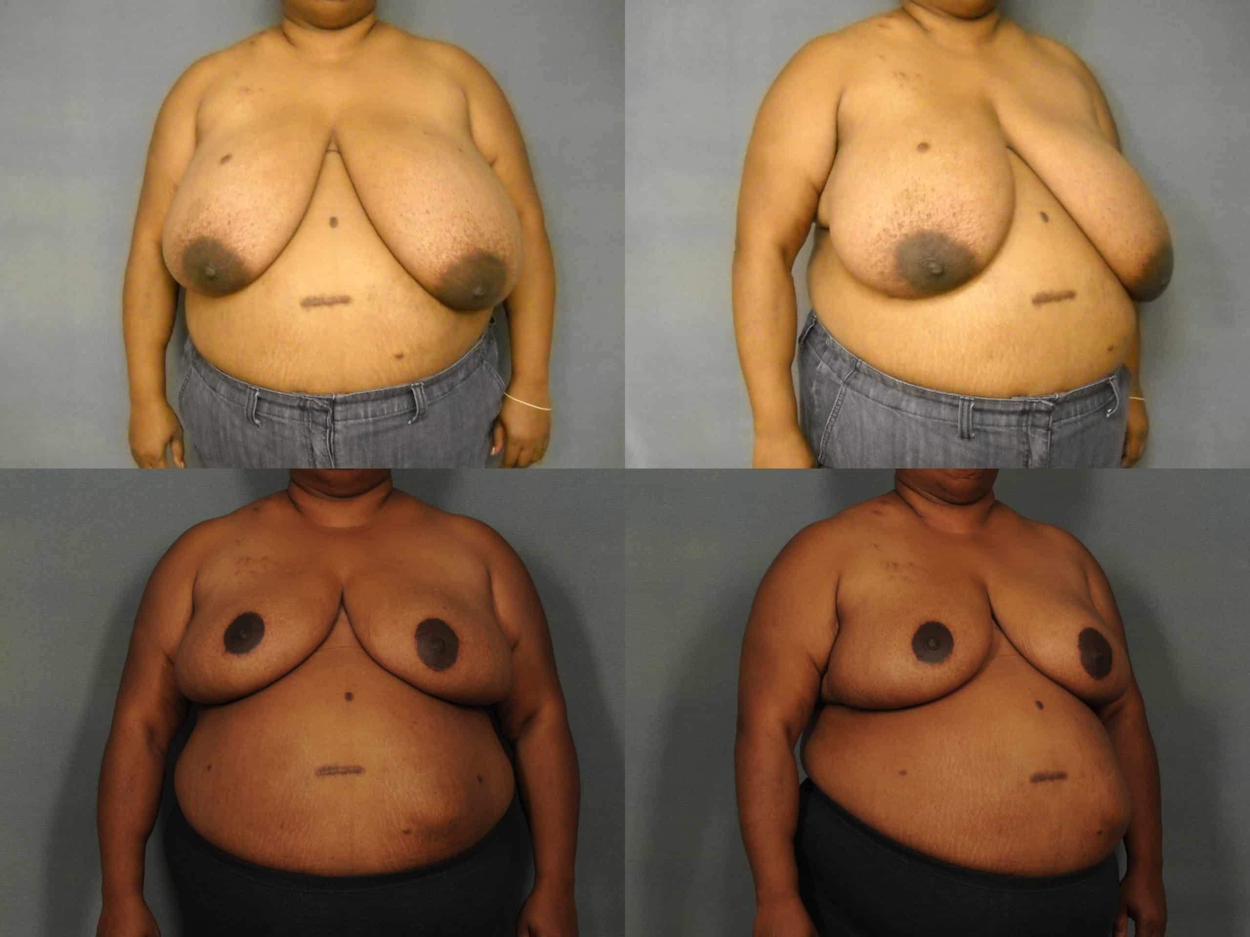Breast Reduction Case #912 Combined Image