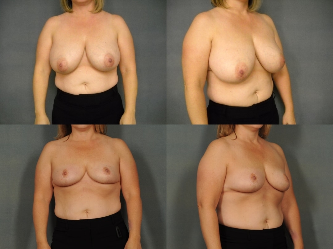 Breast Reduction Case #913 Combined Image