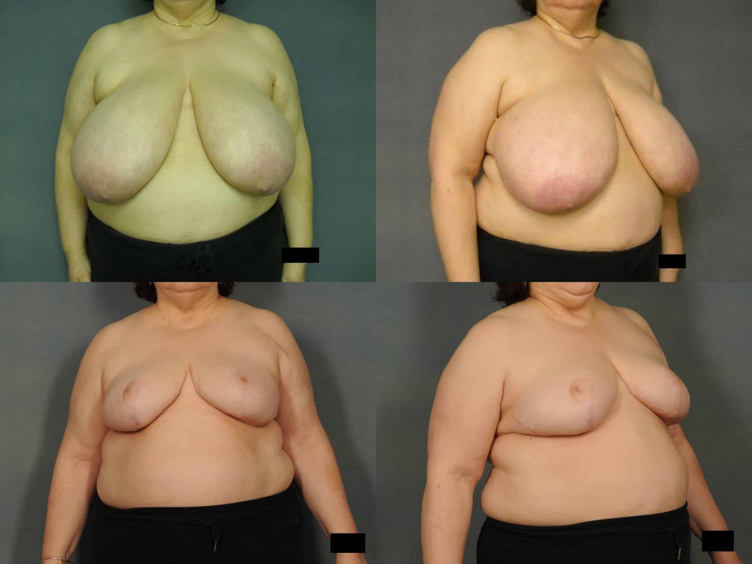 Breast Reduction Case #914 Combined Image