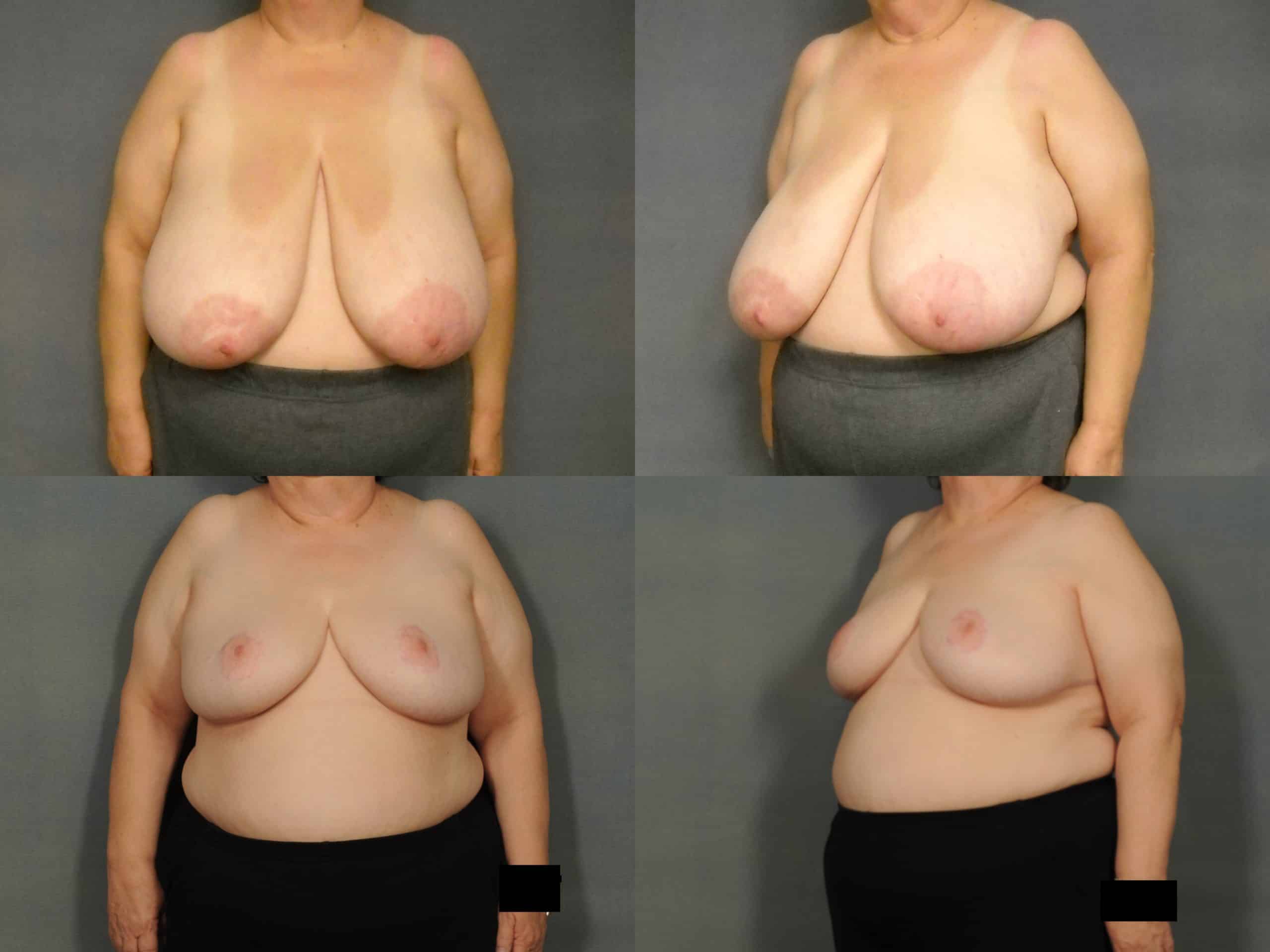 Breast Reduction Case #915 Combined Image