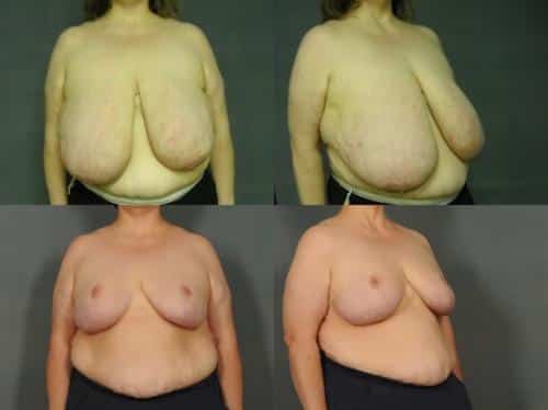 Breast Reduction Case #921 Combined Image