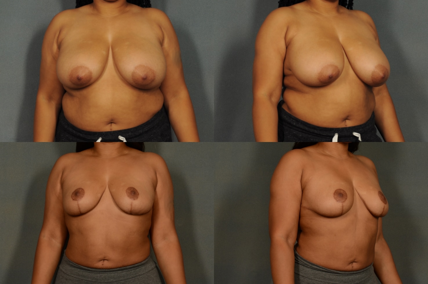 Breast Reduction Case# 925 Combined Image