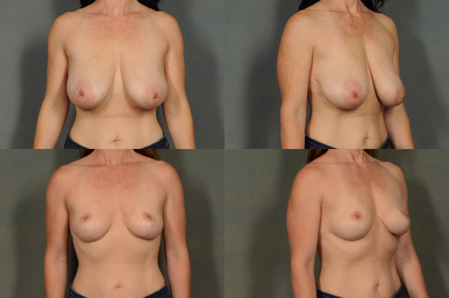 Breast Reduction Case# 926 Combined Image