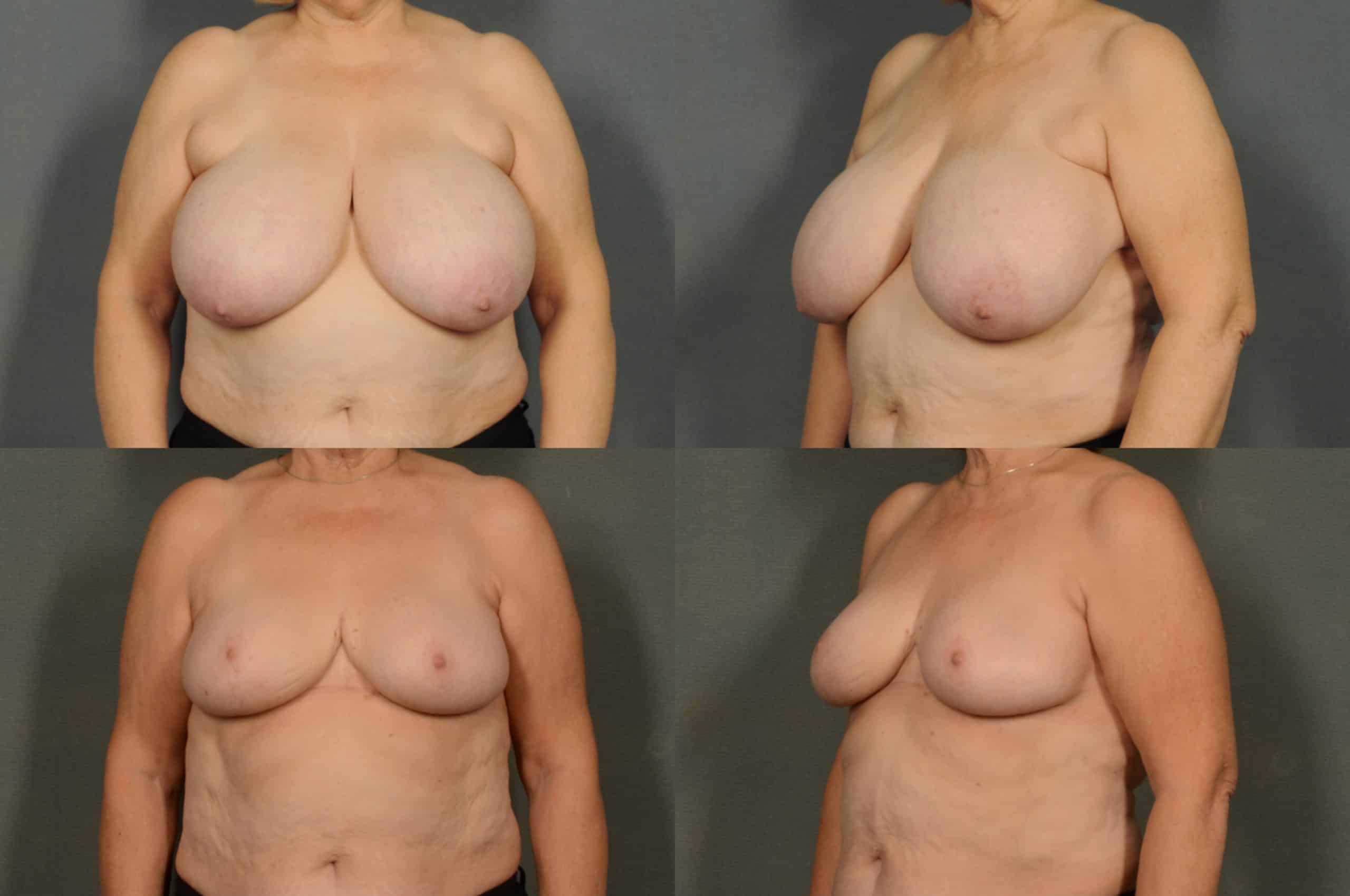 Breast Reduction Case# 930 Combined Image