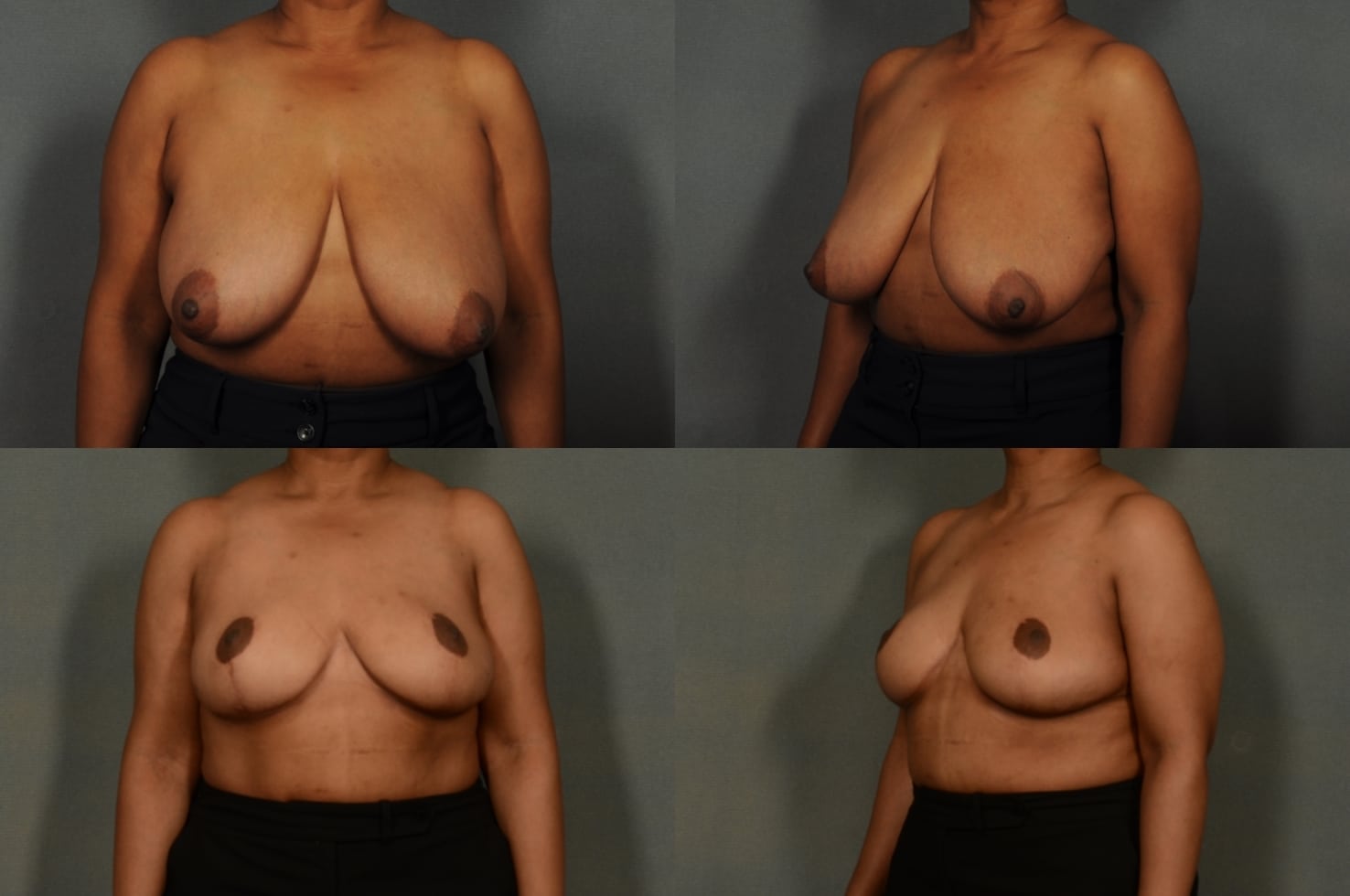Breast Reduction Case# 934 Combined Image