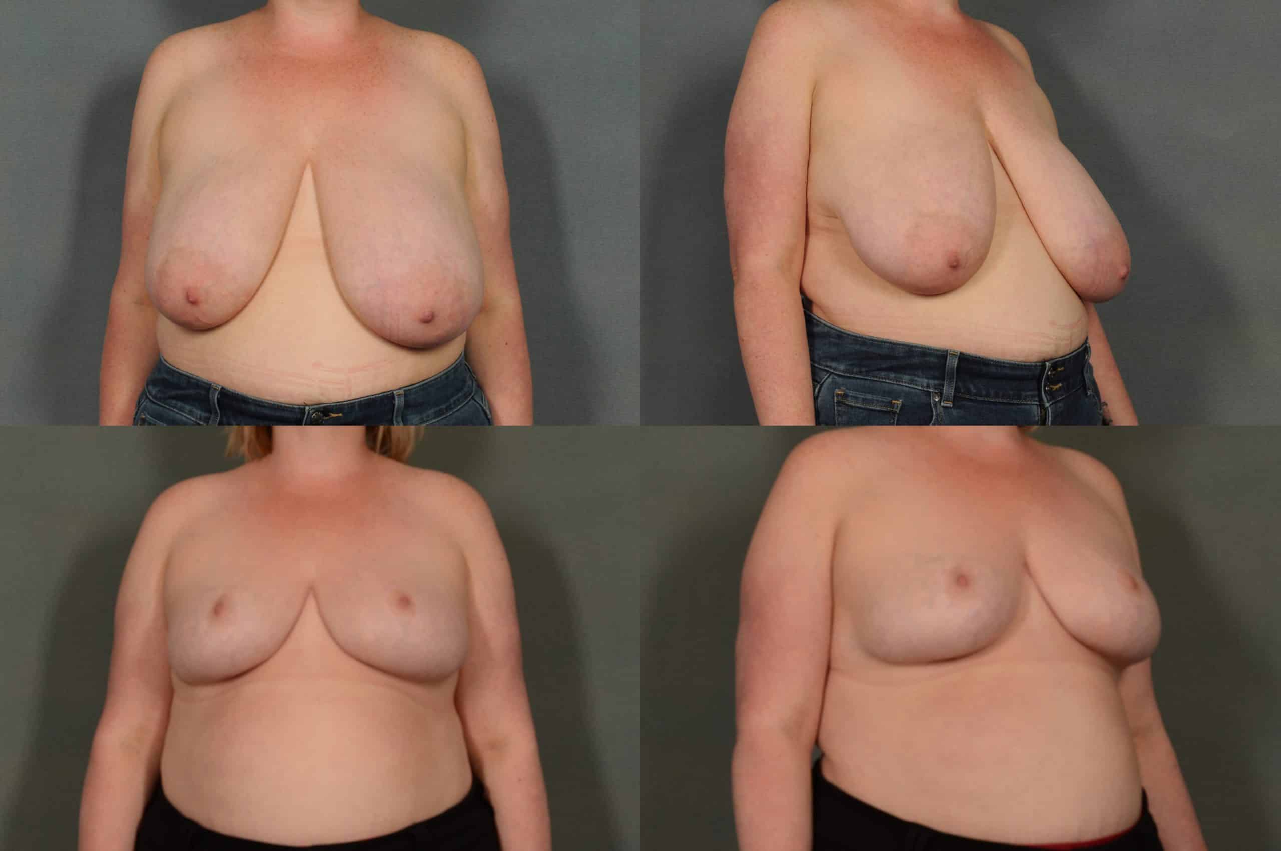 Breast Reduction Case# 942 Combined Image