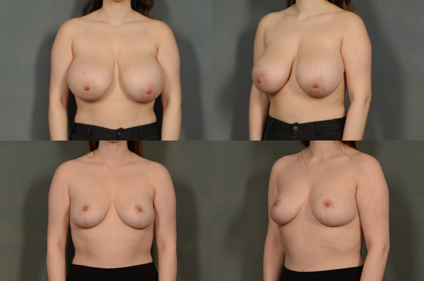 Breast Reduction Case# 943 Combined Image