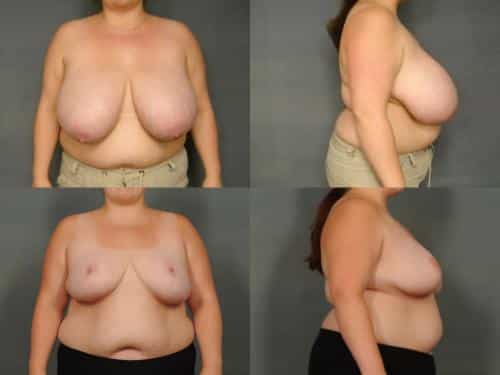 Breast Reduction Case #951 Combined Image