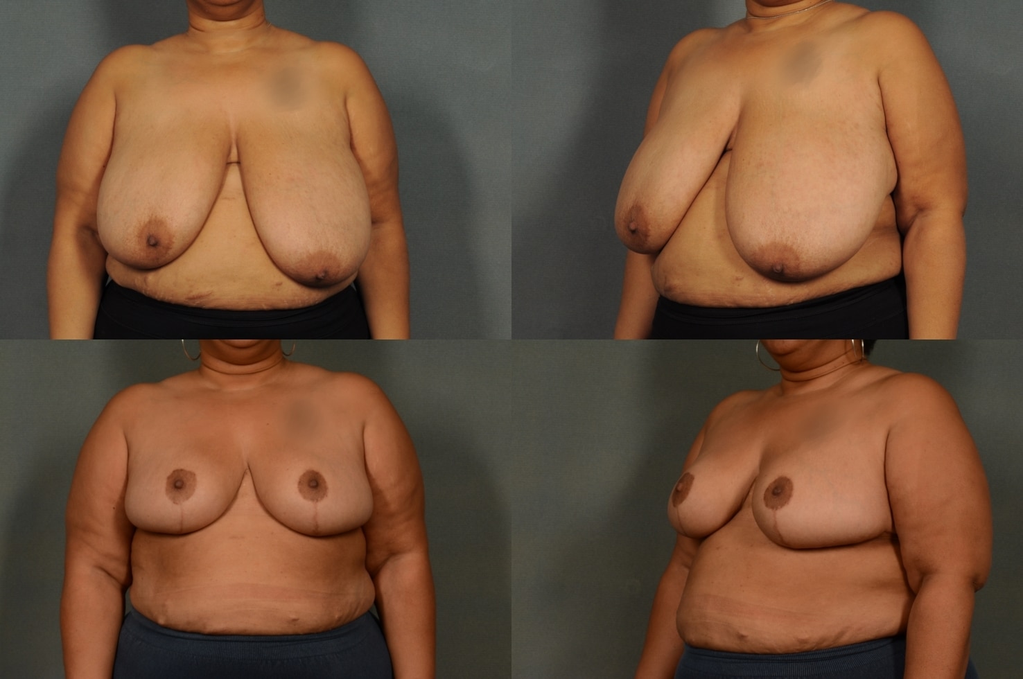 Breast Reduction Case# 952 Combined Image