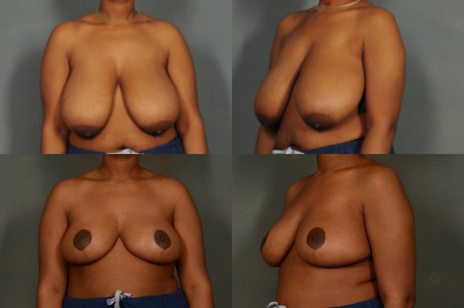 Breast Reduction Case# 954 Combined Image