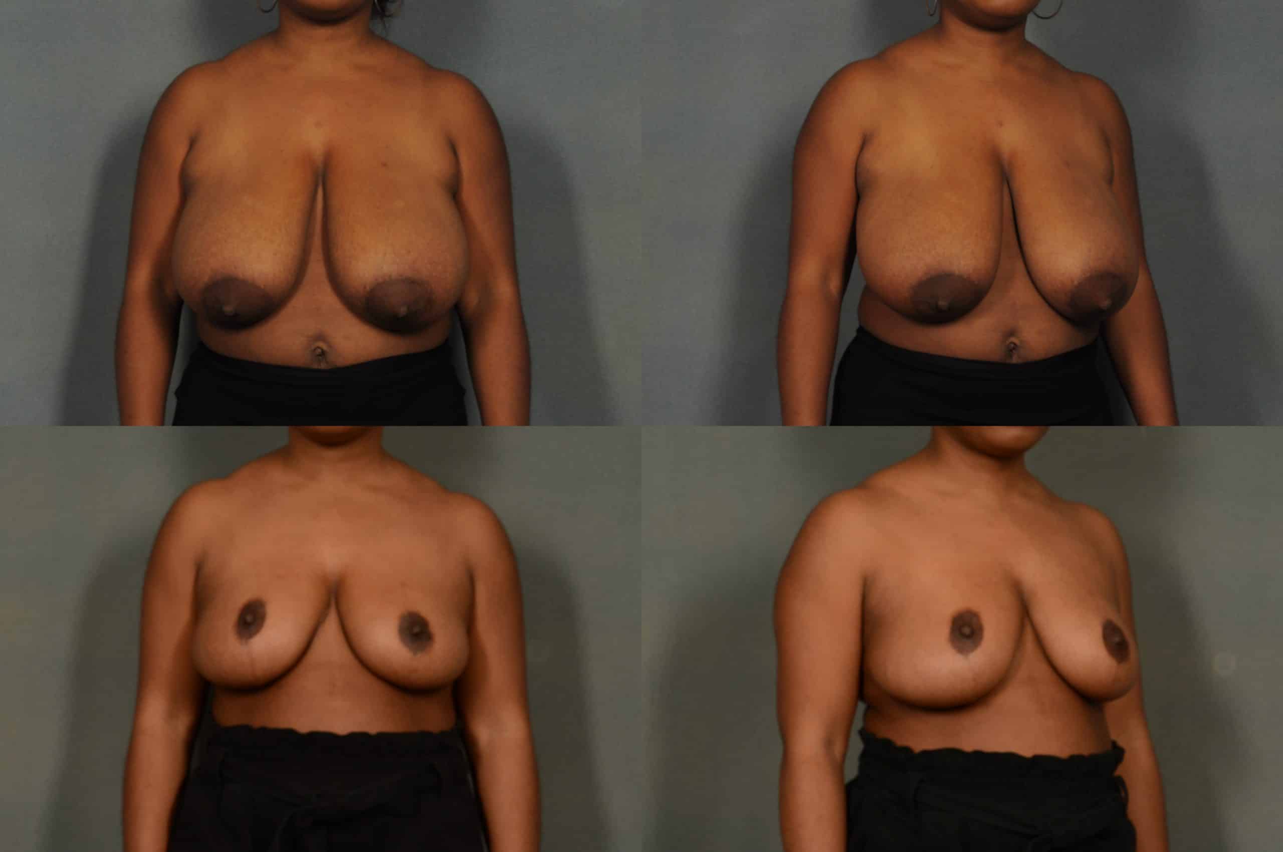 Breast Reduction Case# 956 Combined Image