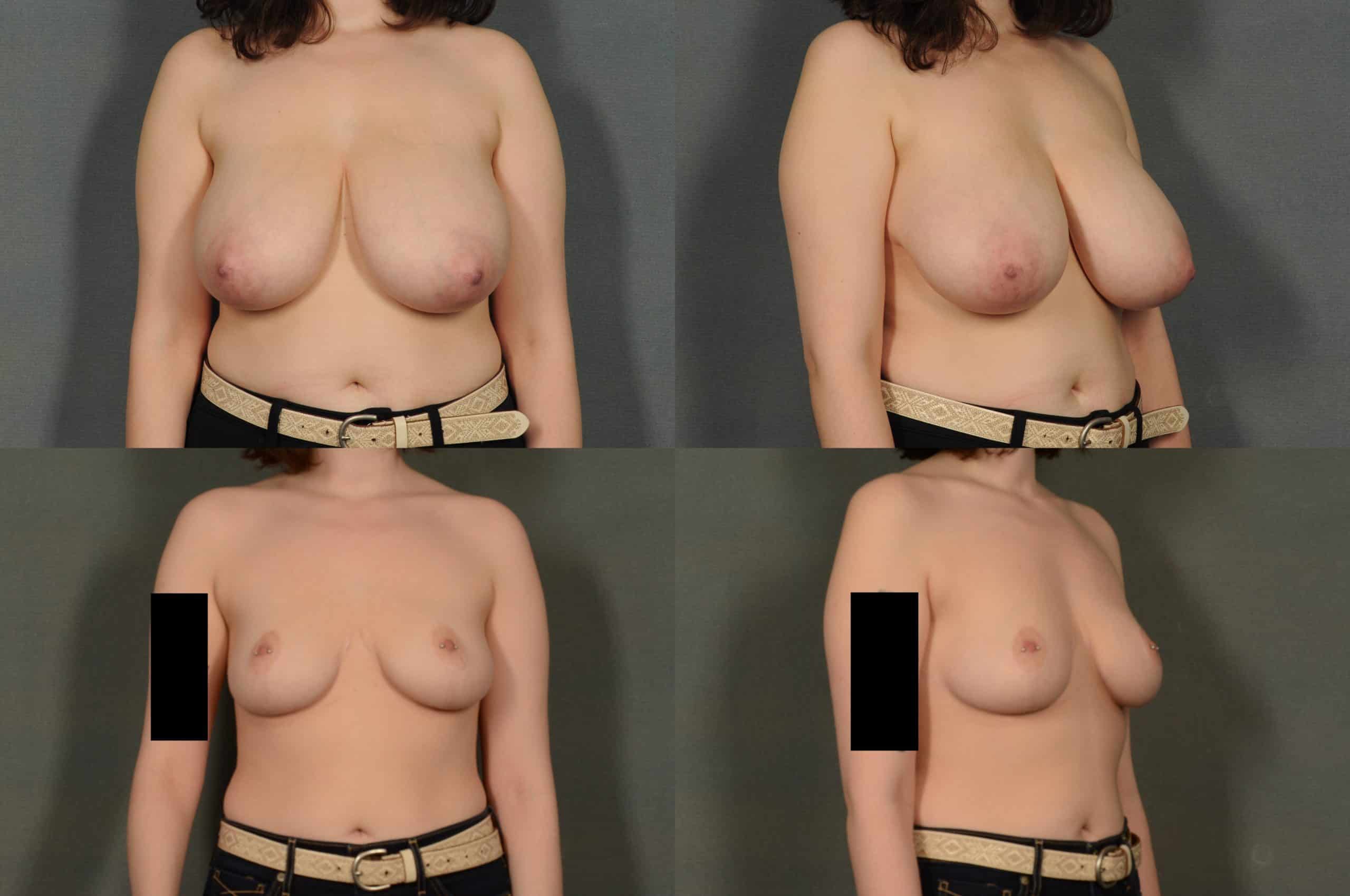 Breast Reduction Case# 957 Combined Image