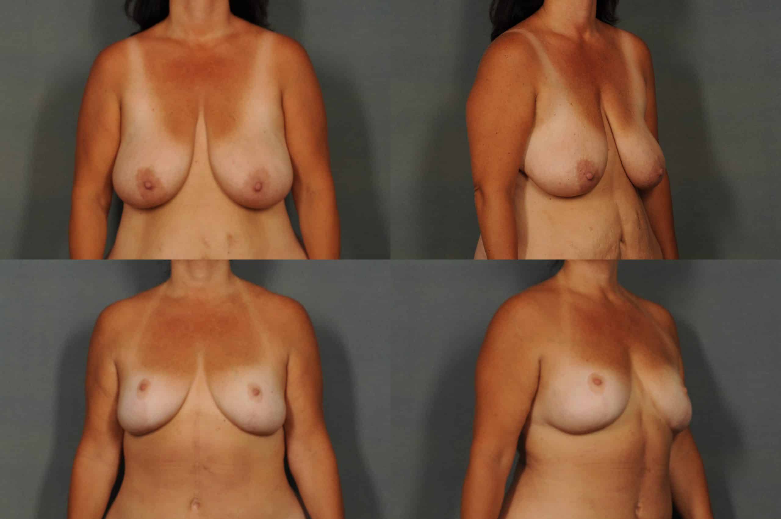 Breast Reduction Case# 960 Combined Image