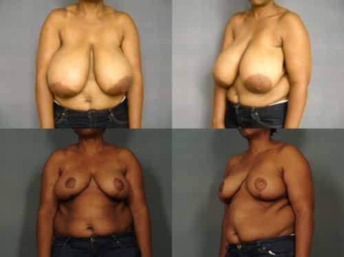 Breast Reduction Case #971 Combined Image