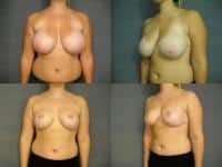 Breast Reduction case#264 Combined Image