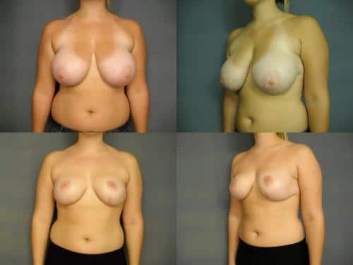 Breast Reduction case#264 Combined Image