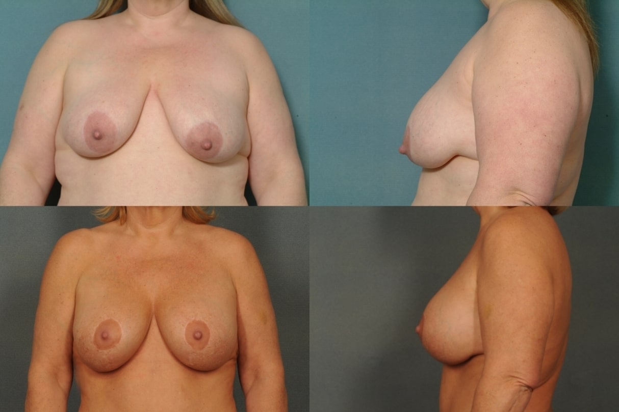 BreastLift with Augmentation Case #766 Combined Image