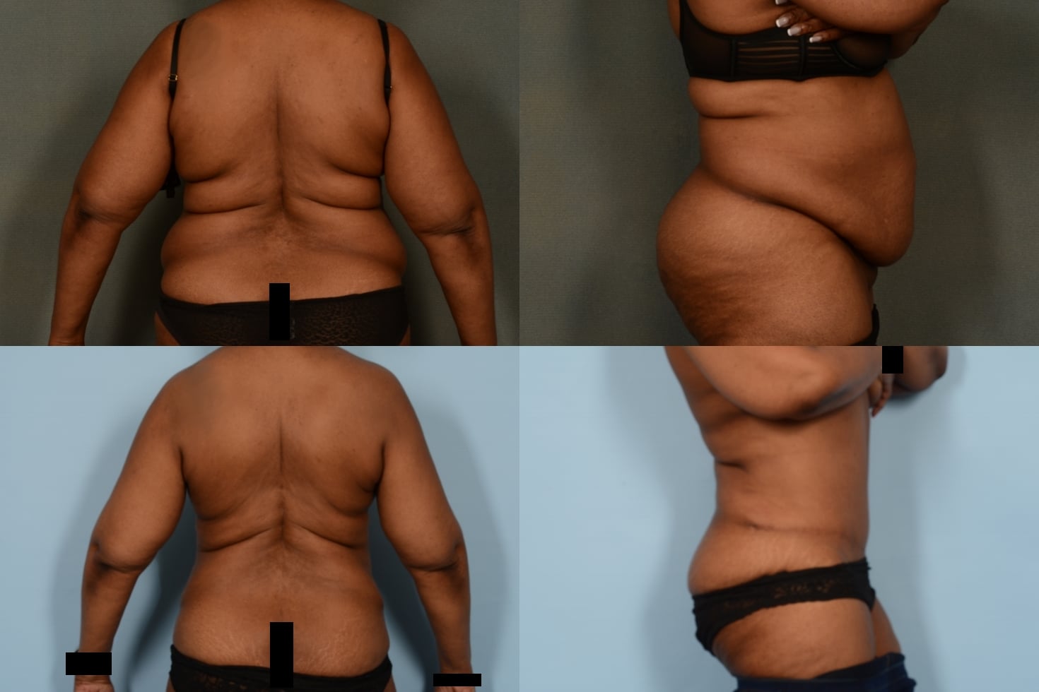 Liposuction Case# 1062 Combined Image