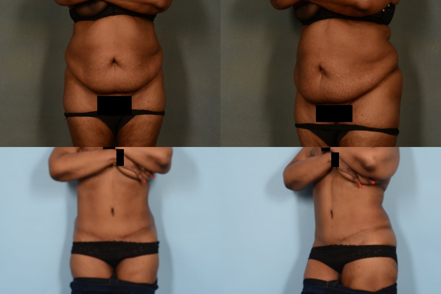 Tummy Tuck Case# 1063 Combined Image