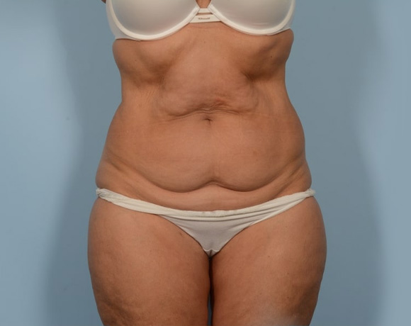 before-image