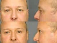 Blepharoplasty Case #303 Combined Image