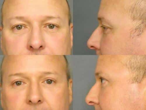 Blepharoplasty Case #303 Combined Image