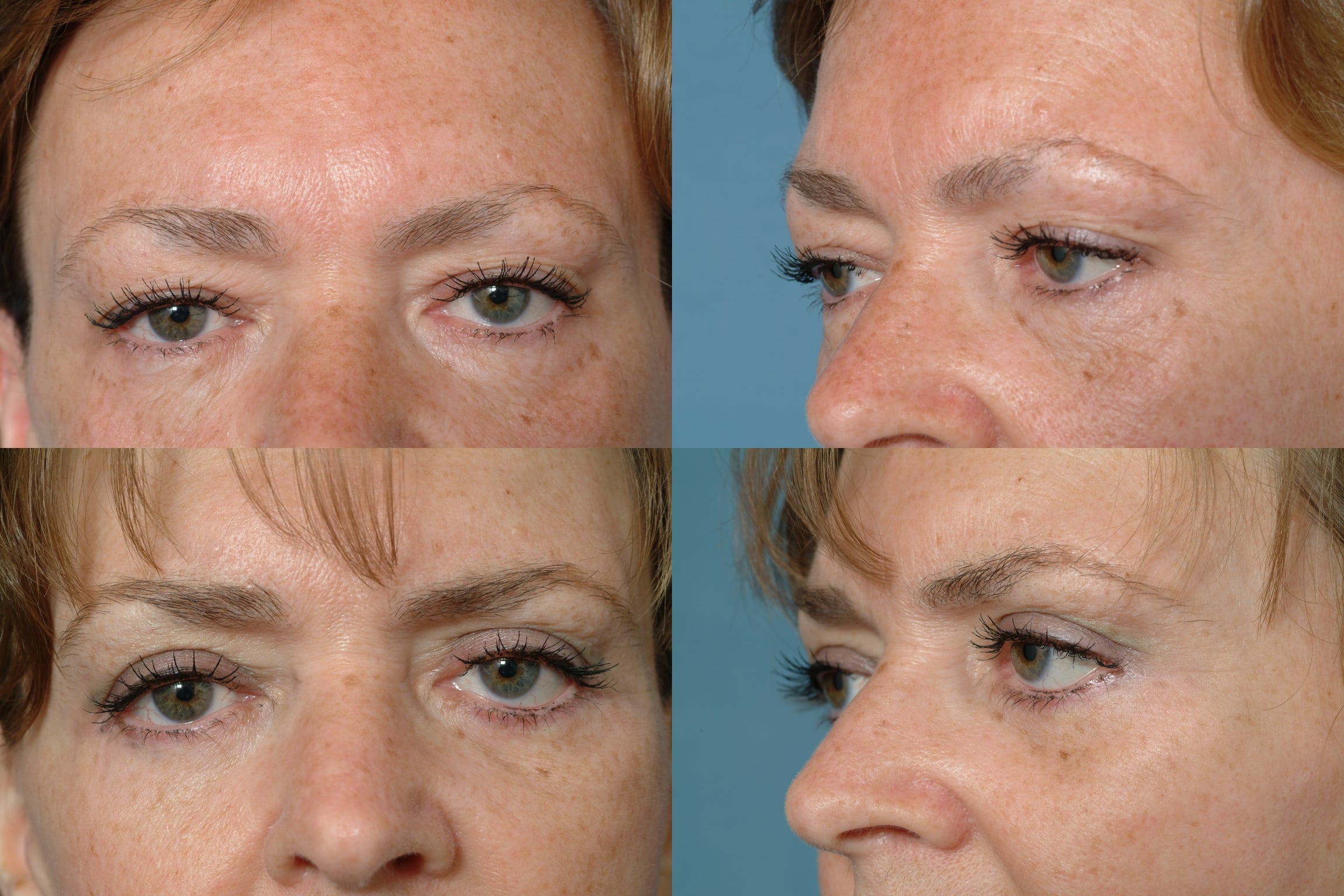 Blepharoplasty Case #313 Combined Image