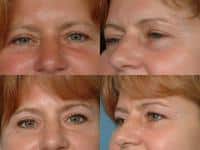 Blepharoplasty Case #341 Combined Image