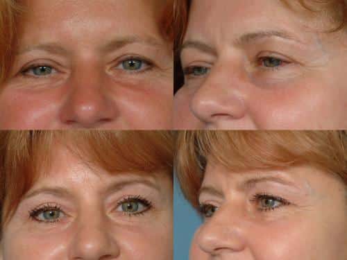Blepharoplasty Case #341 Combined Image