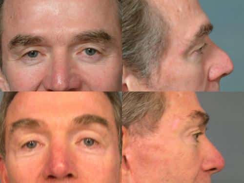 Blepharoplasty Case #361 Combined Image