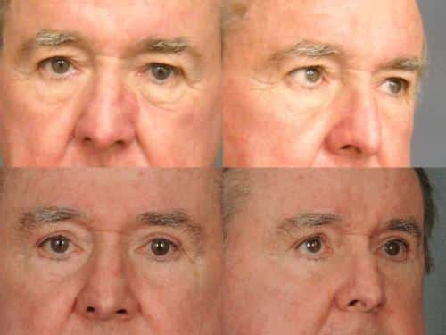Blepharoplasty Case #371 Combined Image