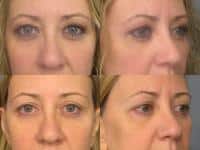 Blepharoplasty Case #401 Combined Image
