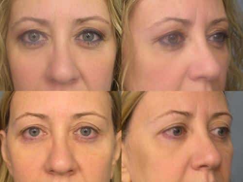 Blepharoplasty Case #401 Combined Image