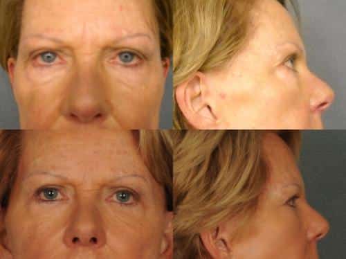 Blepharoplasty Case #991 Combined Image