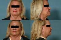Face Lift Case #304 Combined Image