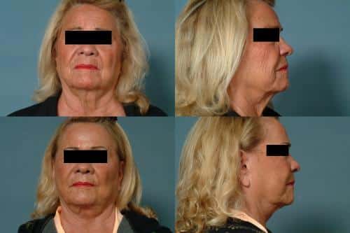 Face Lift Case #304 Combined Image