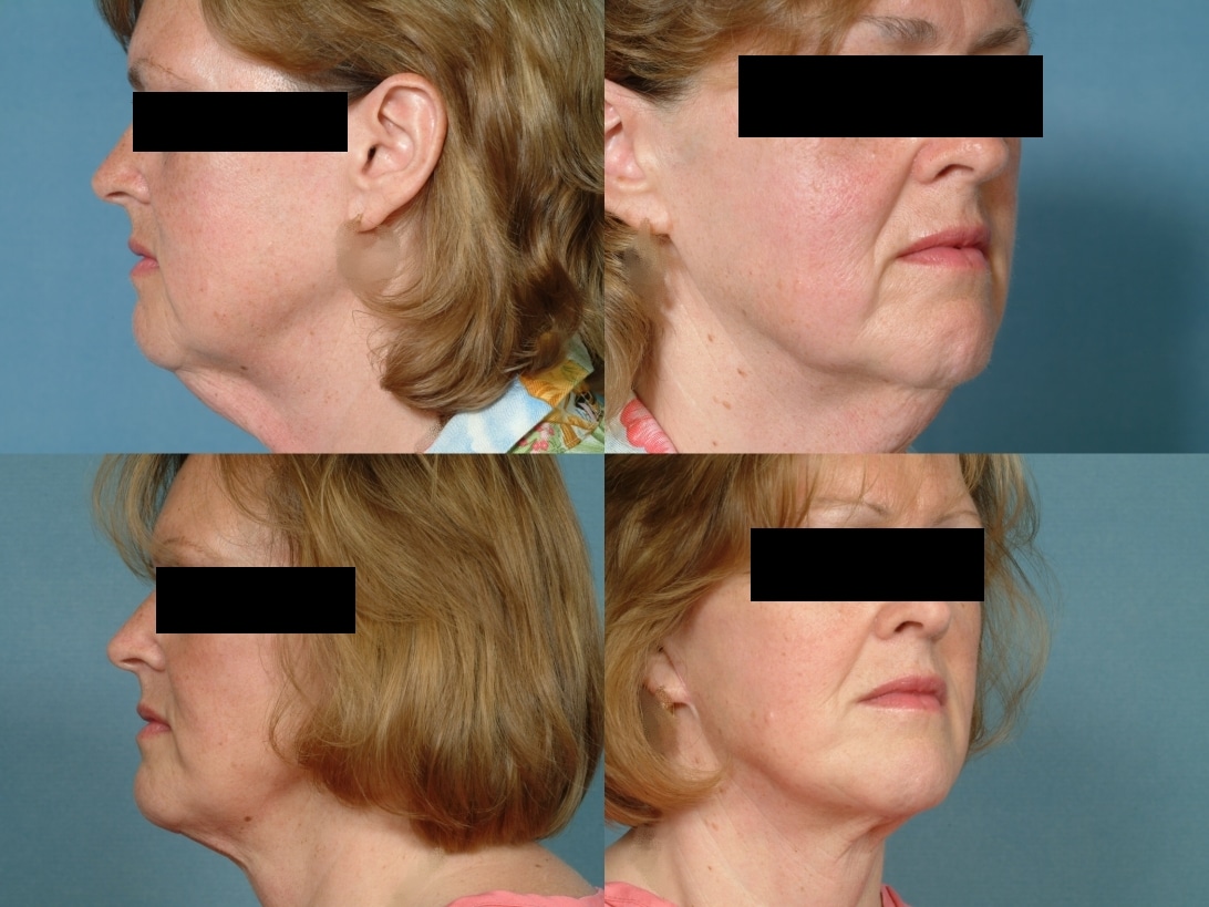 Face Lift Case #314 Combined Image