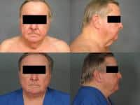 Face Lift Case #381 Combined Image