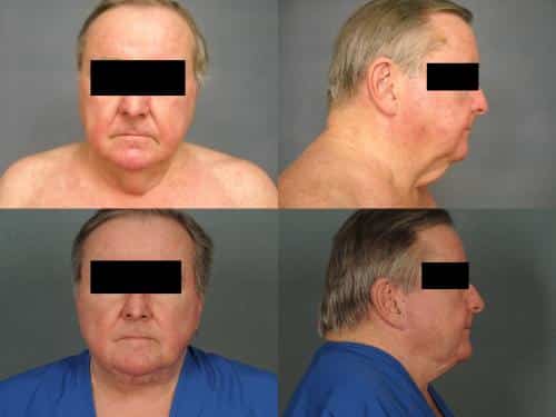 Face Lift Case #381 Combined Image