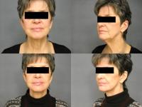 Face Lift Case #391 Combined Image